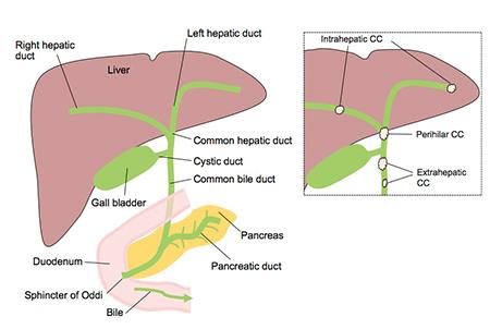 About Cholangiocarcinoma | What is Cholangiocarcinoma?